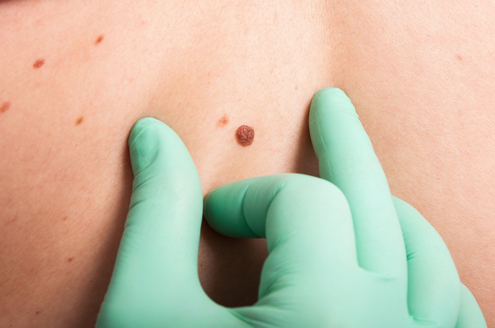 Nueva terapia que combate el melanoma resistente a los tratamientos. (Bigstock) Nueva terapia que combate el melanoma resistente a los tratamientos. (Bigstock)