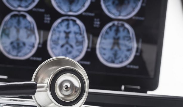 Un estudio identifica con "más precisión" parkinsonismos atípicos mediante resonancias magnéticas