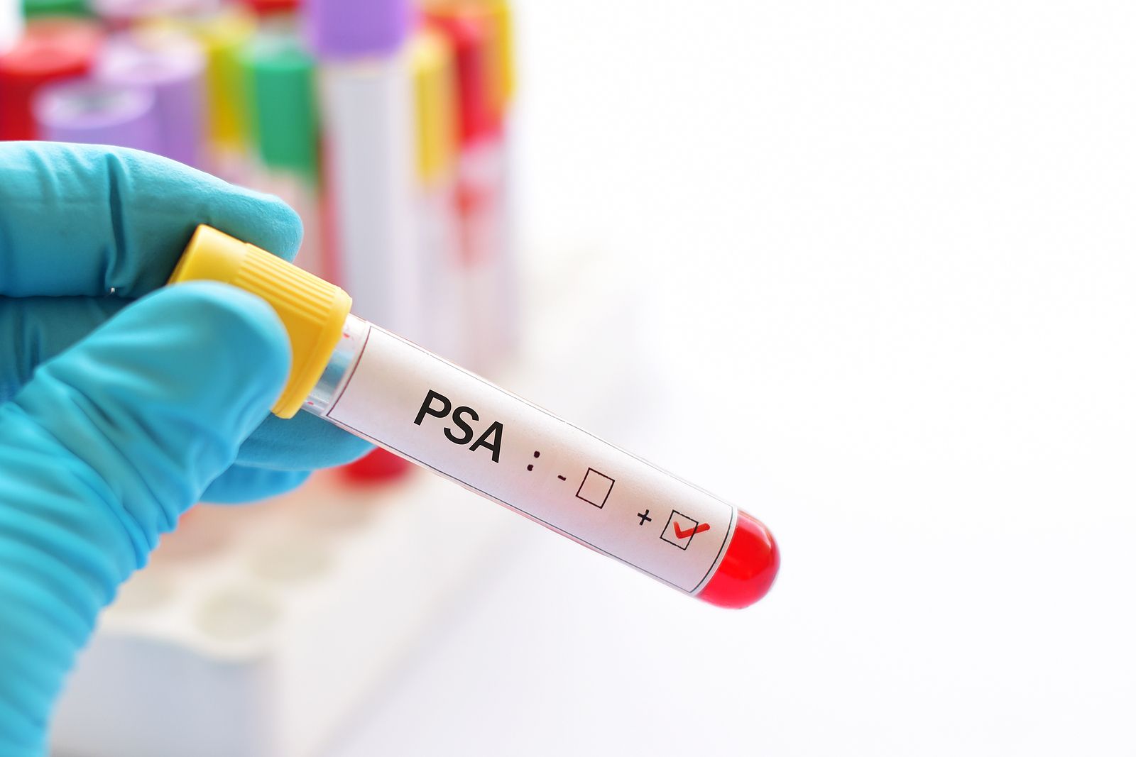Cáncer de próstata: expertos alertan sobre quién realmente necesita la prueba de PSA