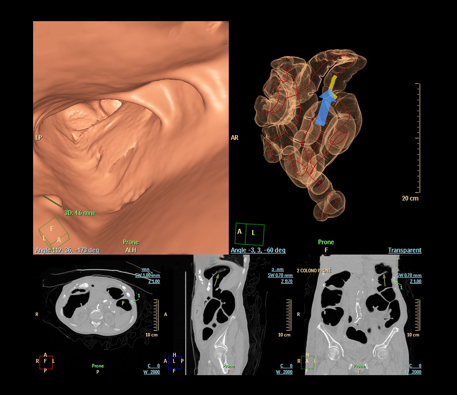La colonoscopia virtual supera a la prueba de heces para la detección del cáncer de colon. (Bigsock) La colonoscopia virtual supera a la prueba de heces para la detección del cáncer de colon. (Bigsock)