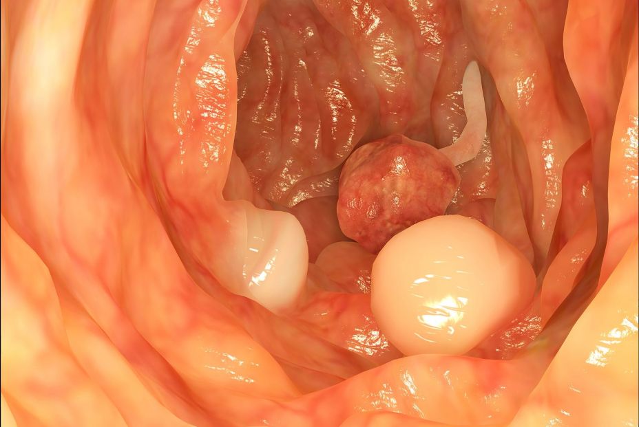 Imagen de pólipos en el colon. (Bigstock) Imagen de pólipos en el colon. (Bigstock)