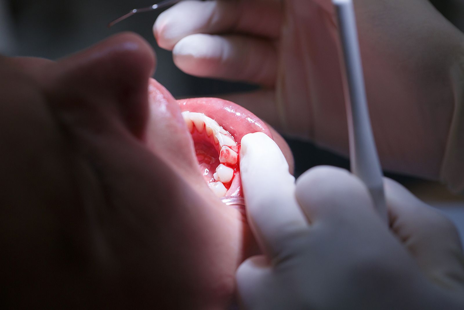 El 'nuevo combo' que reduce la gravedad de la periodontitis. (Bigstock) El 'nuevo combo' que reduce la gravedad de la periodontitis. (Bigstock)