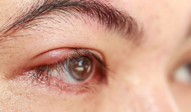 bigstock Right Upper Eye Lid ¿Por qué la llegada del verano nos trae más orzuelos en los párpados? (Bigstock)