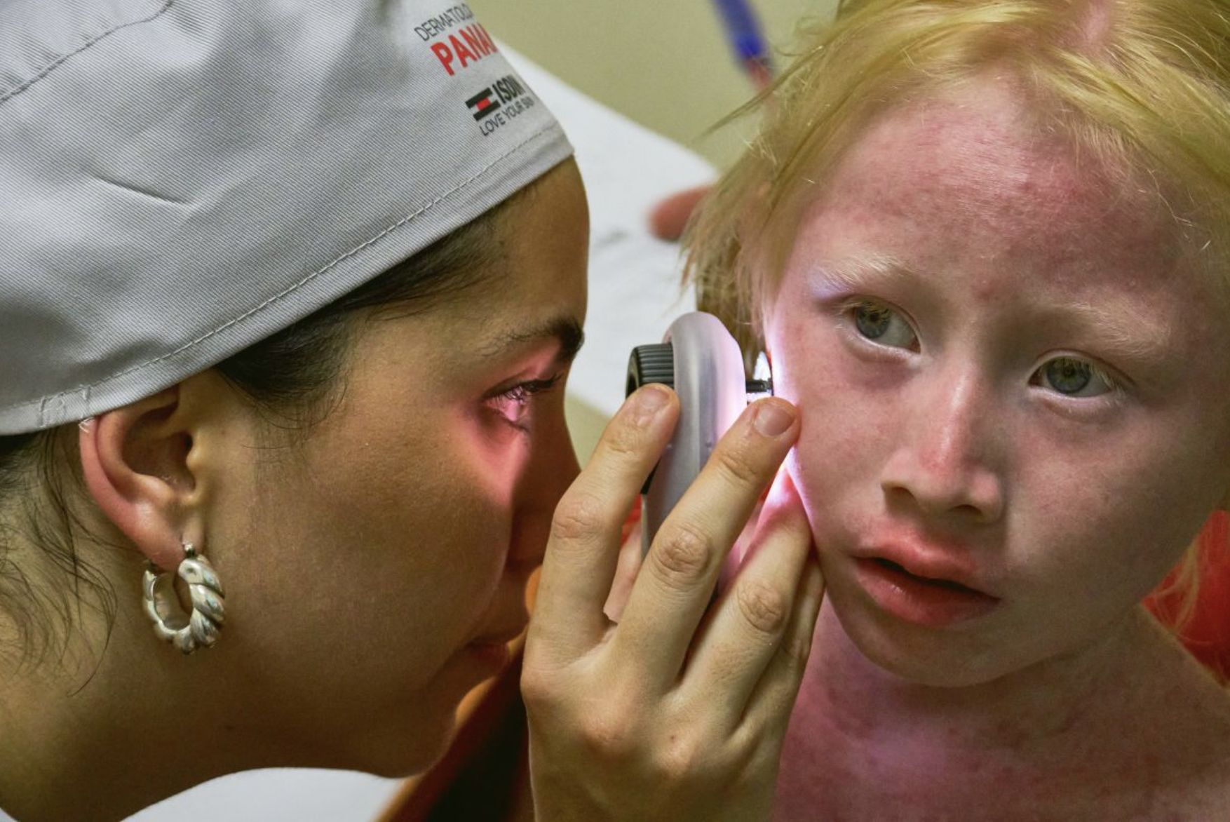 ISDIN atiende a más de cien personas con albinismo en Panamá para luchar contra el cáncer de piel