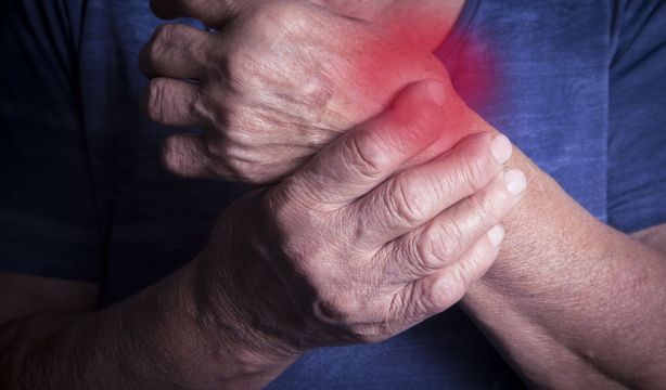 Un paciente con artritis reumatoide. (Bigstock)