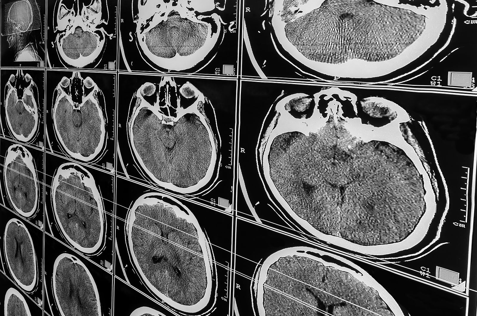 Con un solo escáner cerebral ya se puede determinar como envejece el cerebro. (Bigstock)