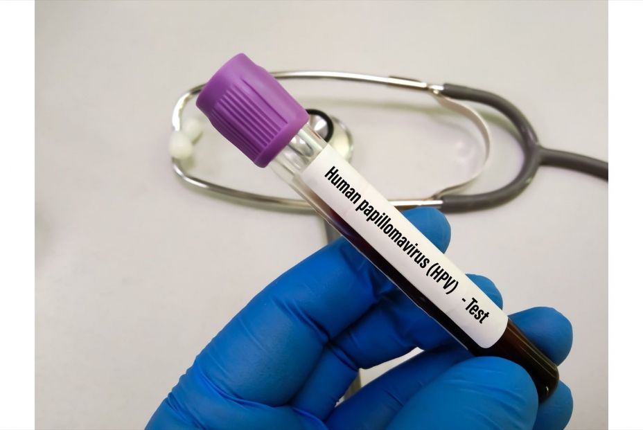 EuropaPress 5468526 virus papiloma humano vph EuropaPress 5468526 virus papiloma humano vph