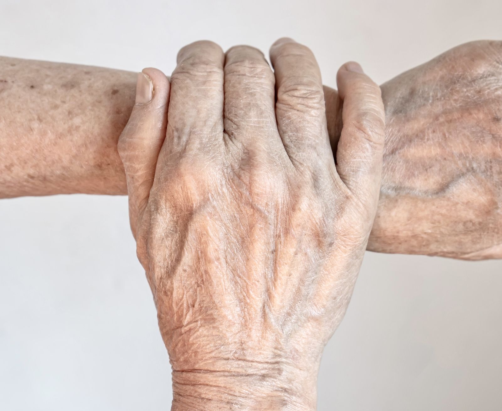 Identifican una pista clave en la mano para diagnosticar la artritis reumatoide de forma precoz