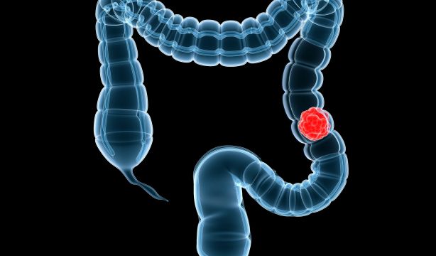 La periodontitis podría aumentar el riesgo de cáncer colorrectal, según un estudio