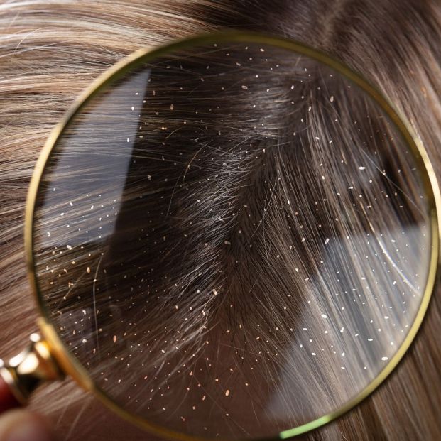 Descamación del cuero cabelludo en mayores