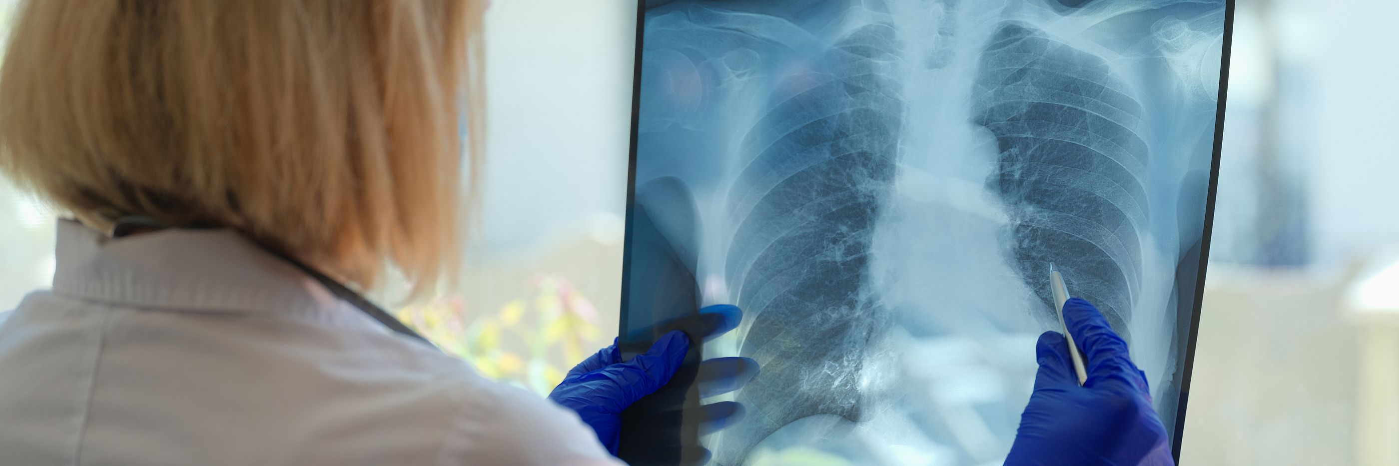 La fibrosis pulmonar idiopática, una enfermedad incurable