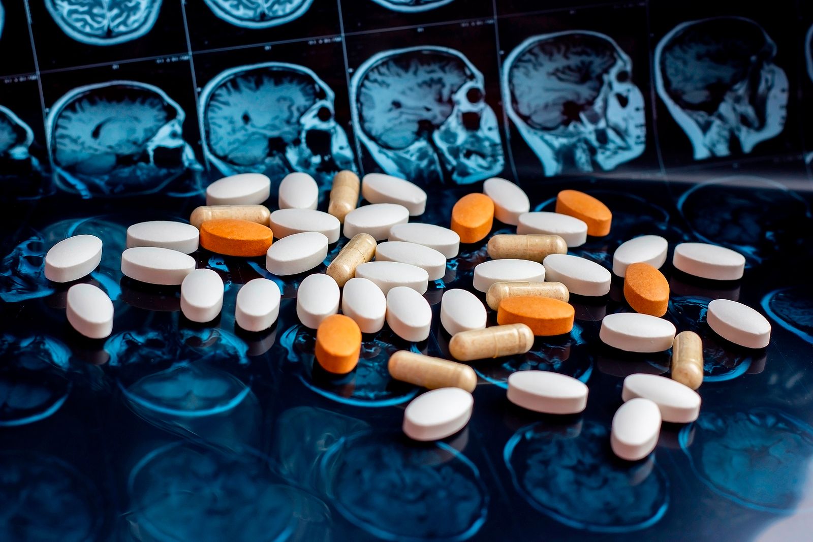 Dos fármacos contra el cáncer, esperanza contra el alzhéimer (Bigstock)