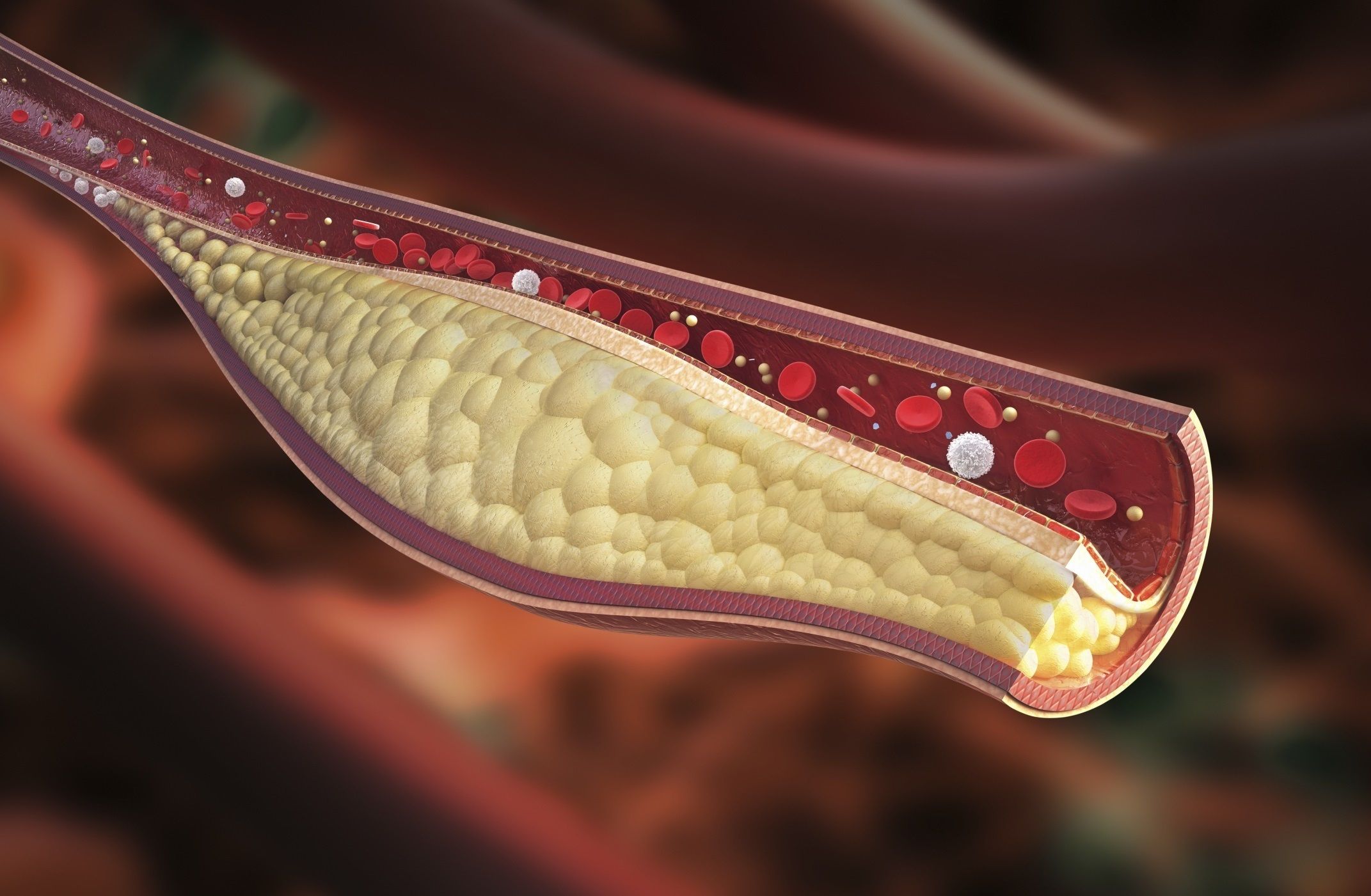 Investigadores españoles descubren una nueva vía para combatir la aterosclerosis