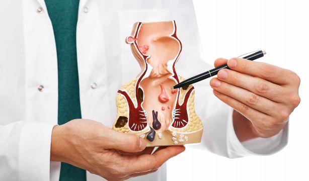 Por qué las hemorroides empeoran en verano y cómo prevenirlo