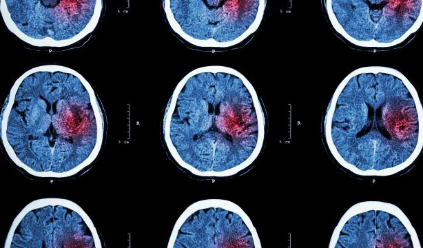 Un anticoagulante reduce el riesgo de ictus sin más hemorragias