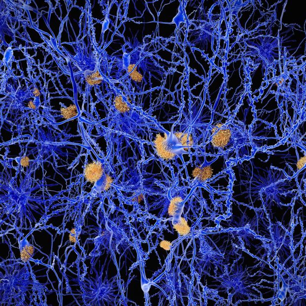 Imagen de neuronas afectadas por el alzhéimer. (Bigstock)