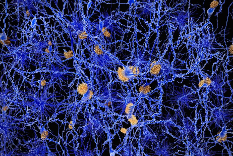 bigstock Alzheimer disease neurons wit 103463741 bigstock Alzheimer disease neurons wit 103463741
