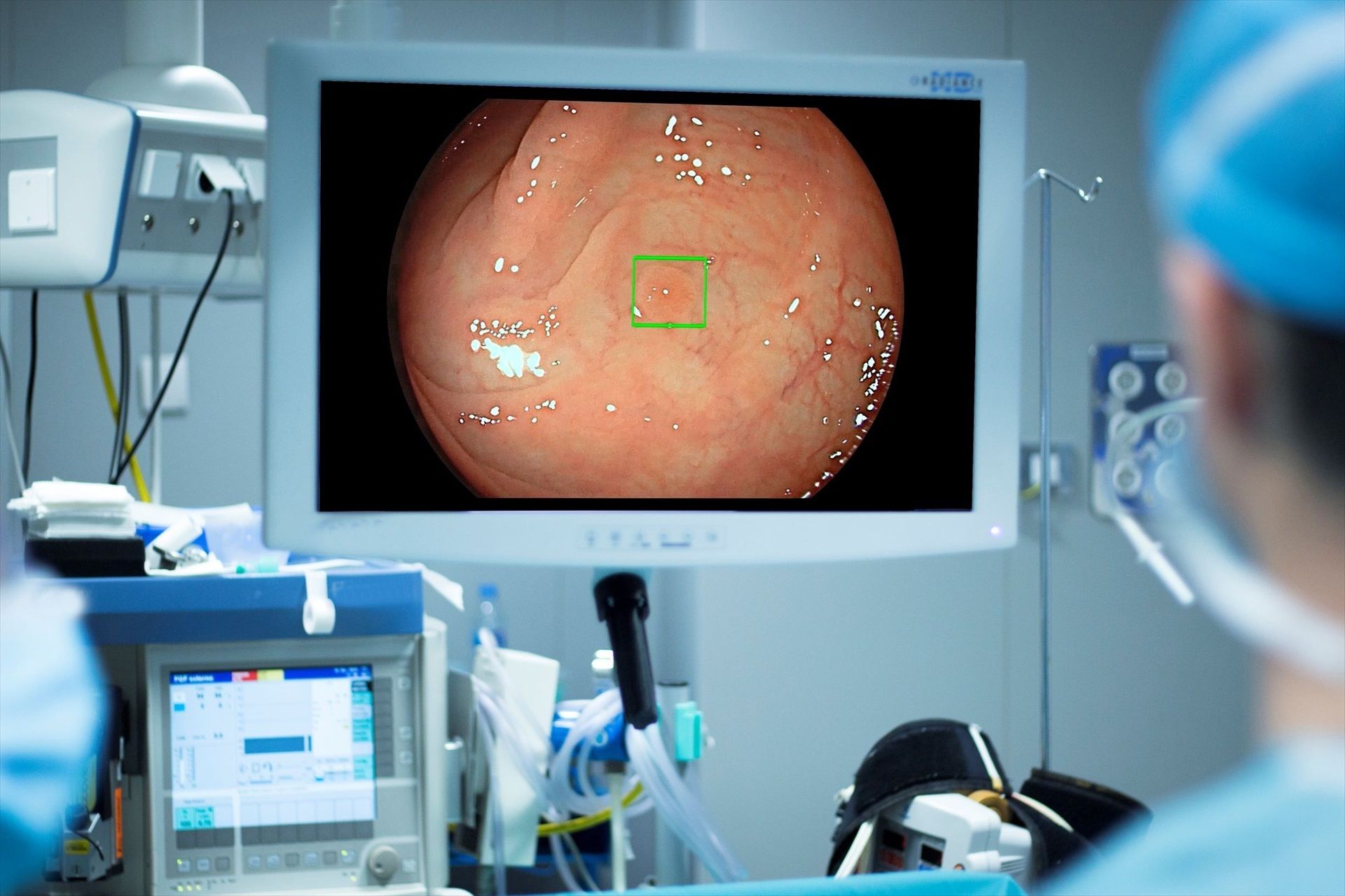 Los dos pólipos en el intestino que multiplican por cinco el riesgo de cáncer