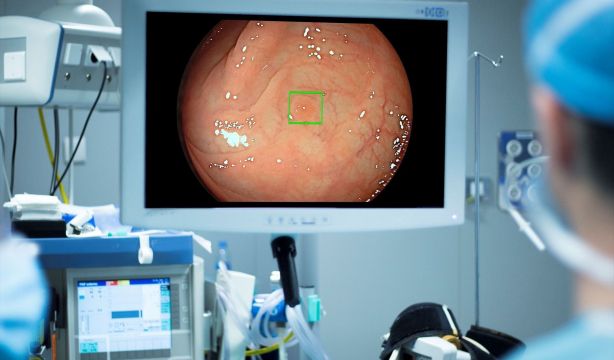 Los dos pólipos en el intestino que multiplican por cinco el riesgo de cáncer