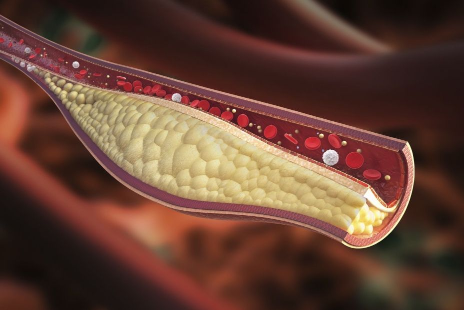 Descubren que una técnica de imagen podría ayudar a tratar la aterosclerosis Descubren que una técnica de imagen podría ayudar a tratar la aterosclerosis