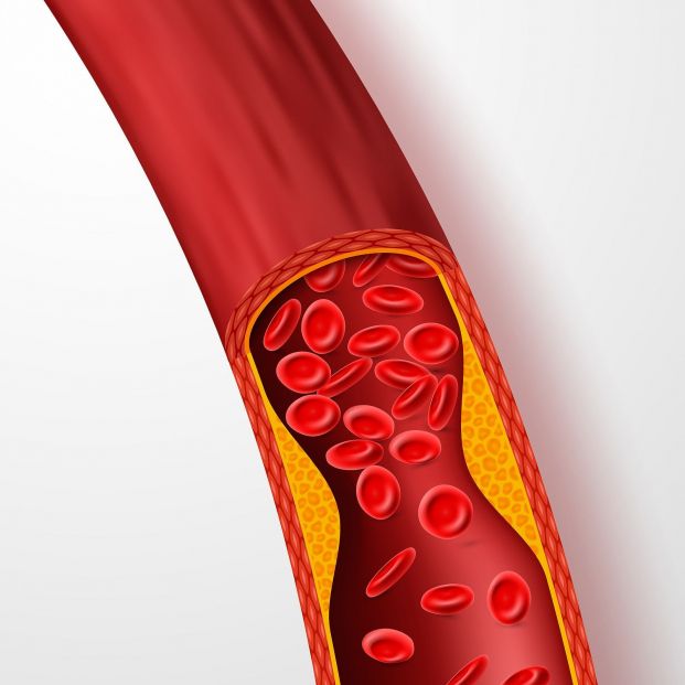 bigstock blocked blood vessel artery w 253491925 bigstock blocked blood vessel artery w 253491925