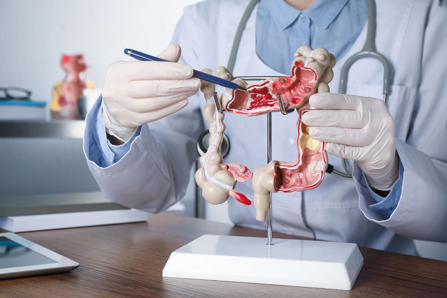 Cáncer de colon en menores de 50 años: este es el síntoma que no debes ignorar