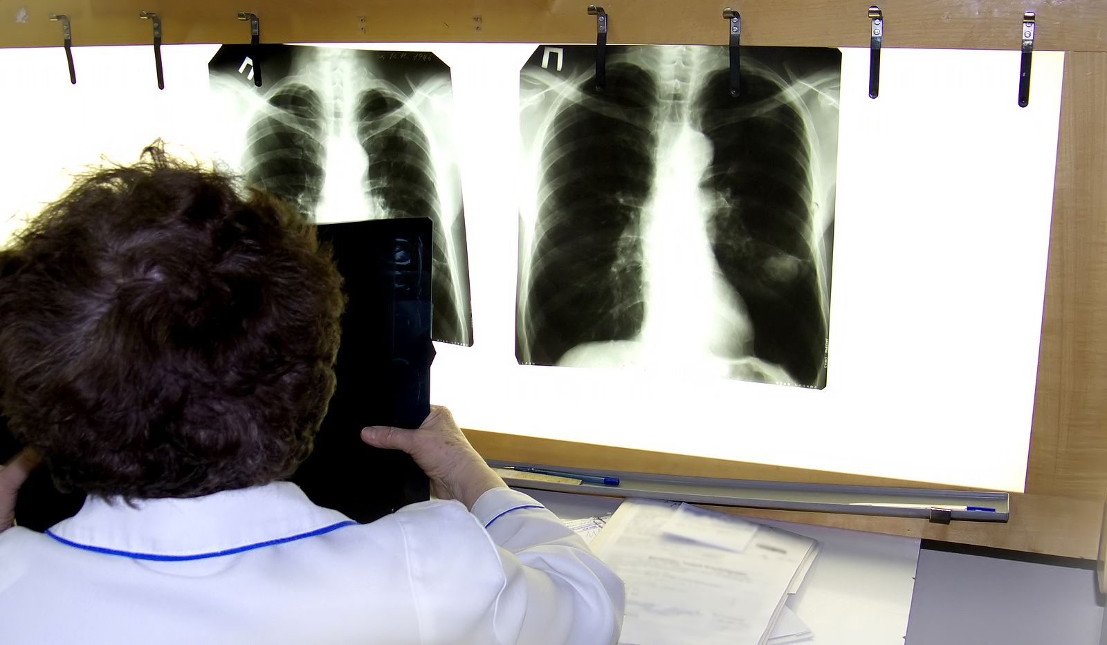 Un médico examina una radiografía de cáncer de pulmón. Fuente: Bigstock