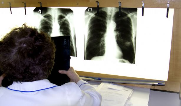 Un médico examina una radiografía de cáncer de pulmón. Fuente: Bigstock