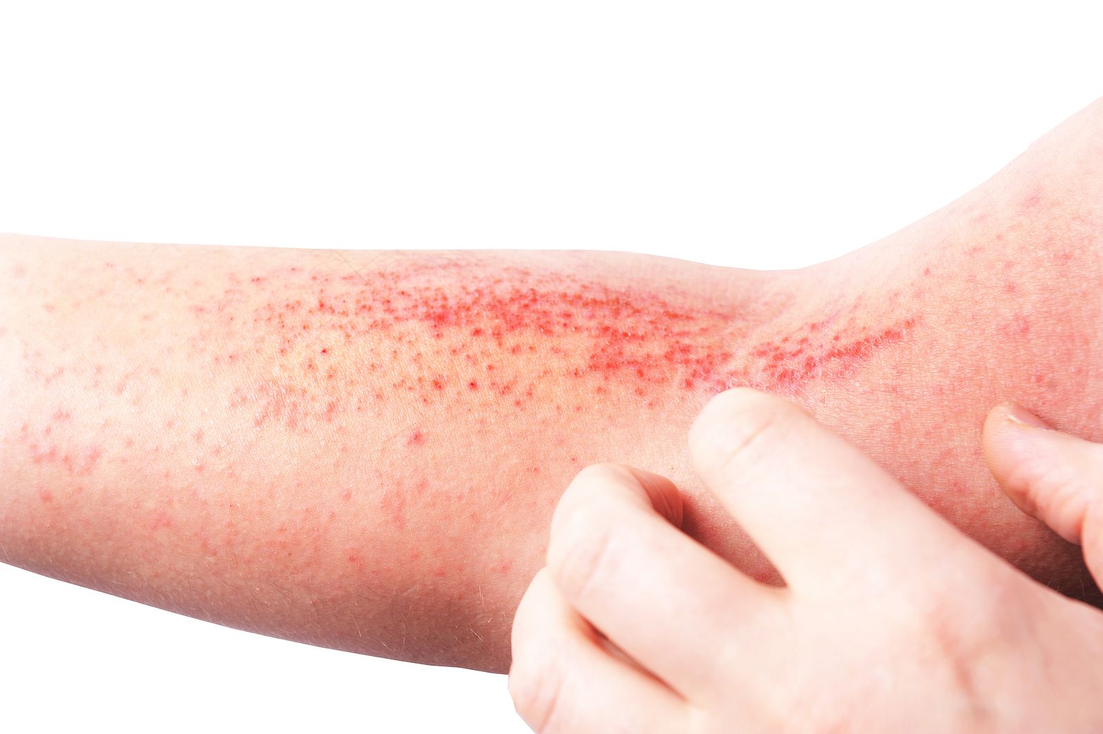 Dermatitis atópica: la enfermedad de la piel infravalorada (Bigstock)