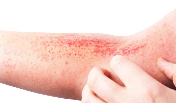 Dermatitis atópica: la enfermedad de la piel infravalorada (Bigstock)