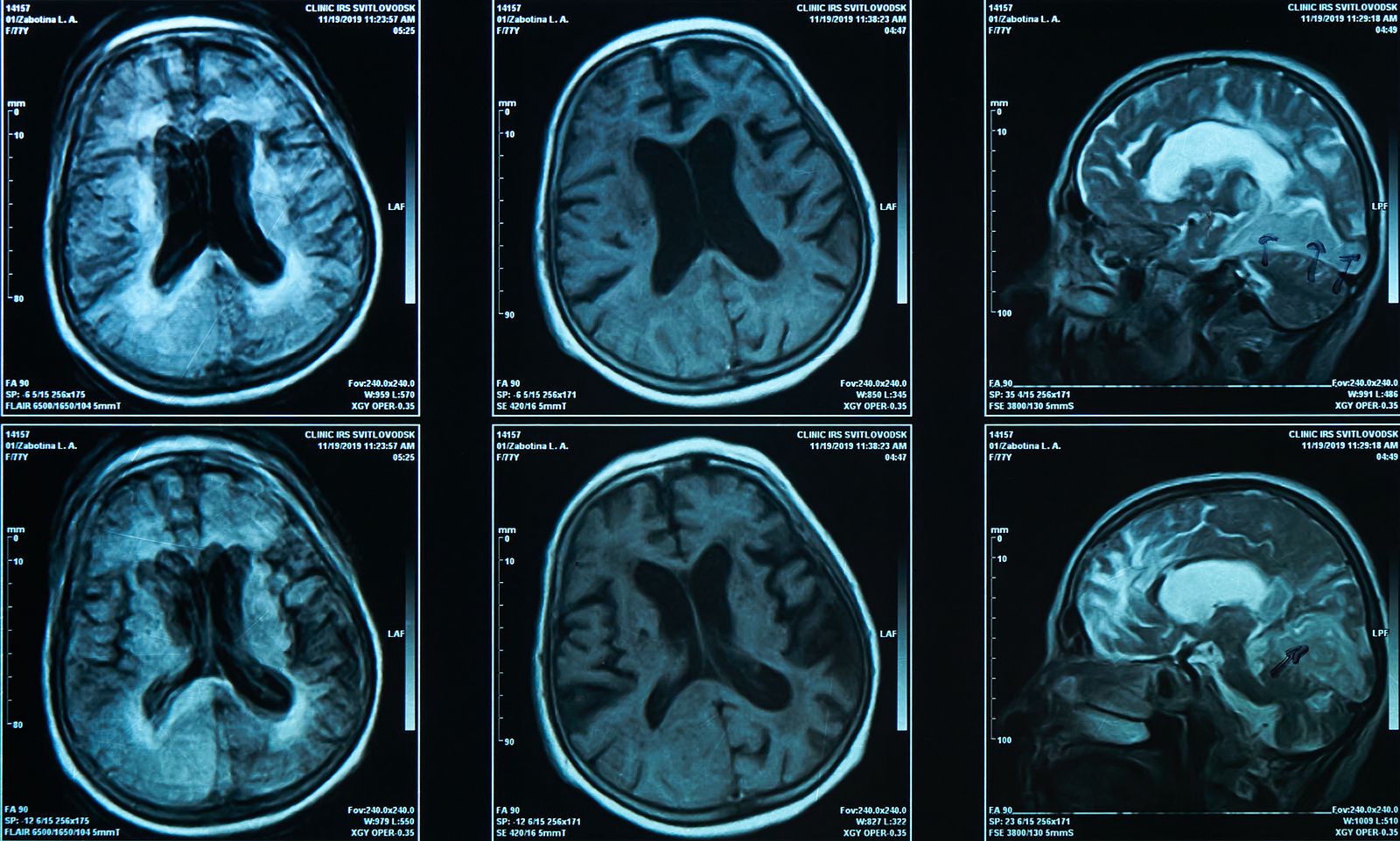 Niveles de hierro en el cerebro podrían indicar riesgo de alzhéimer