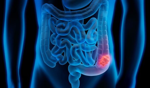 El cáncer colorrectal será el tumor más diagnosticado en 2026: la prevención, clave para los mayores