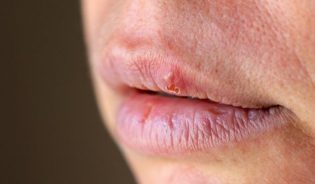Descubren un nuevo antiviral contra el herpes simple resistente a los tratamientos