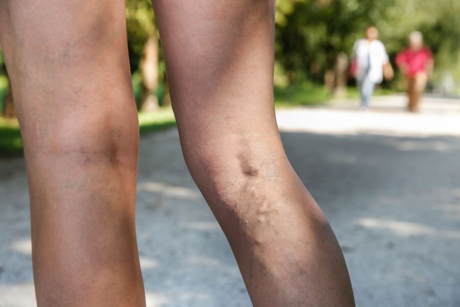 Especialista advierte que las varices pueden duplicar el riesgo de sufrir insuficiencia cardíaca