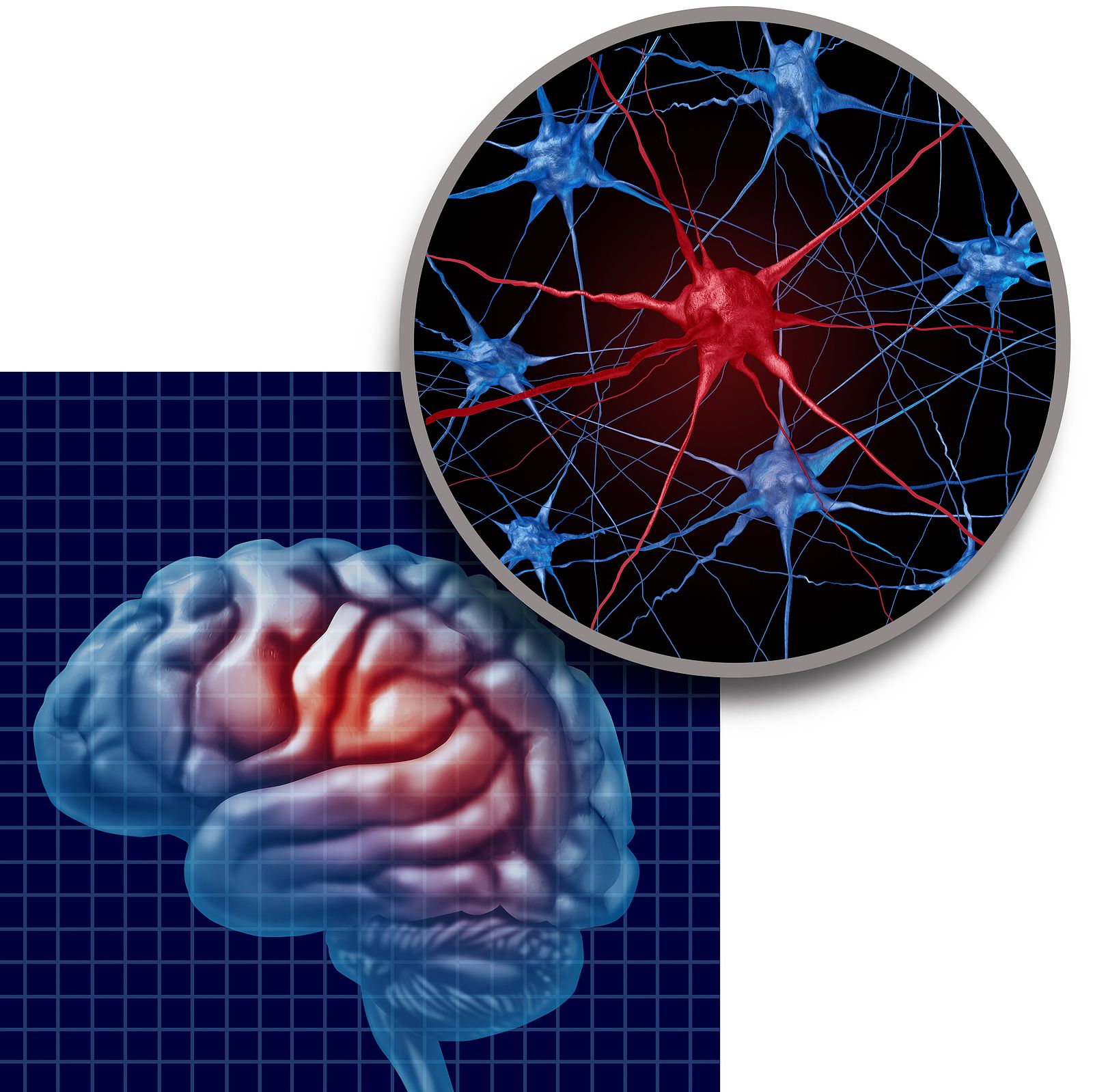 Observan por primera vez el desencadenante del párkinson en el tejido cerebral(Bigstock)