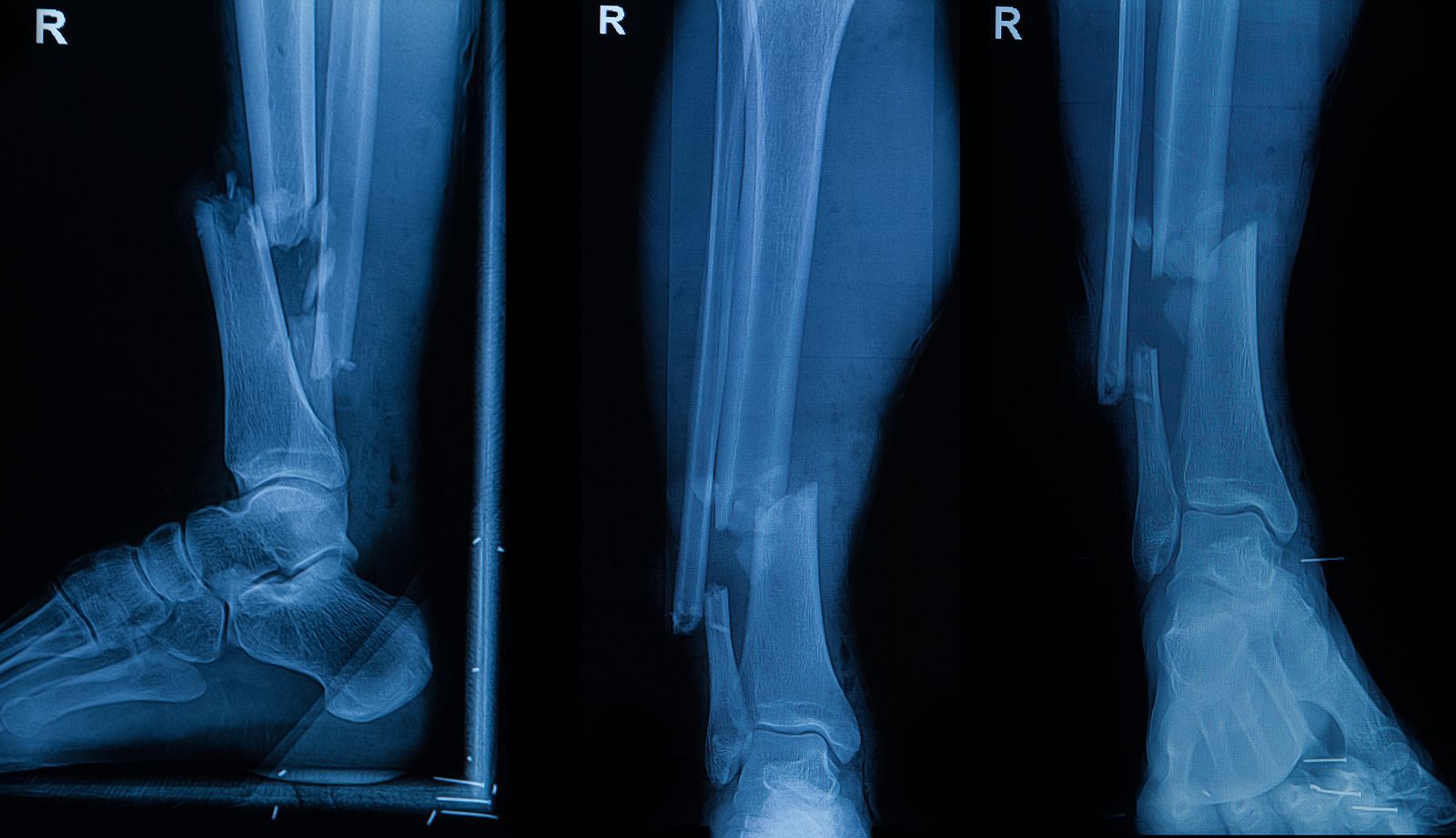 Crean un 'pegamento' que repara las fracturas en 3 minutos (Bigstock)