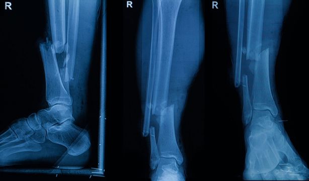 Crean un 'pegamento' que repara las fracturas en 3 minutos (Bigstock)