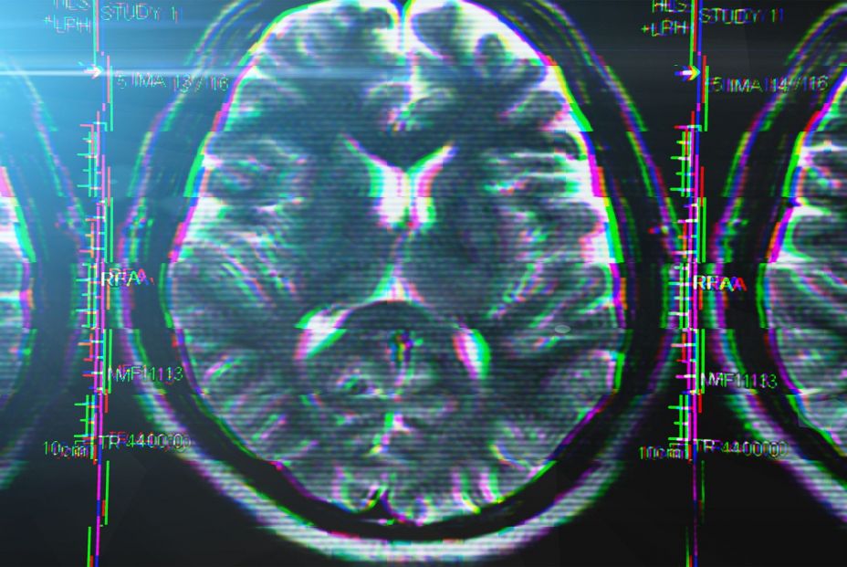 bigstock X ray Or Mri Brain Scan With G 233511862 (1) bigstock X ray Or Mri Brain Scan With G 233511862 (1)
