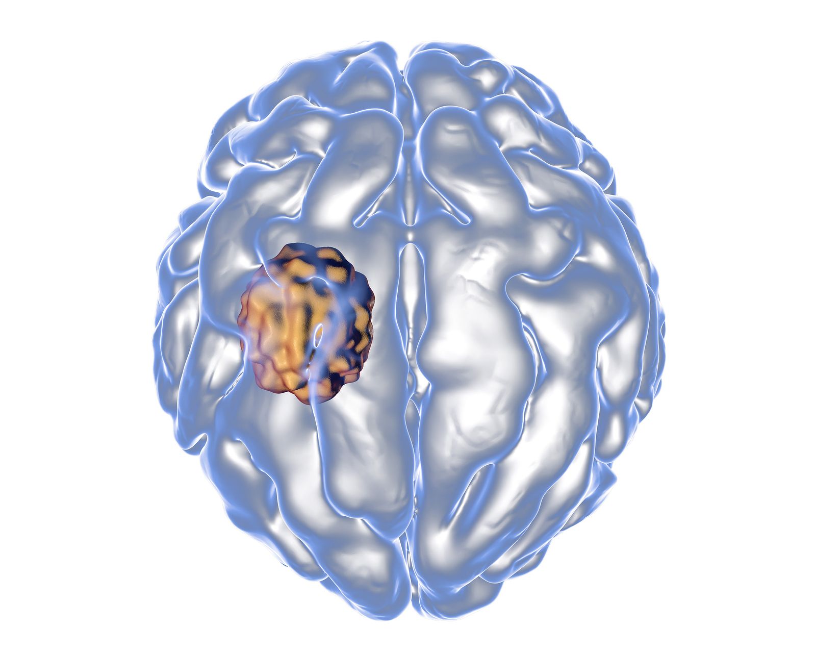 Un estudio descubre nuevas lesiones en las conmociones cerebrales que posibilitan alternativas de tratamiento