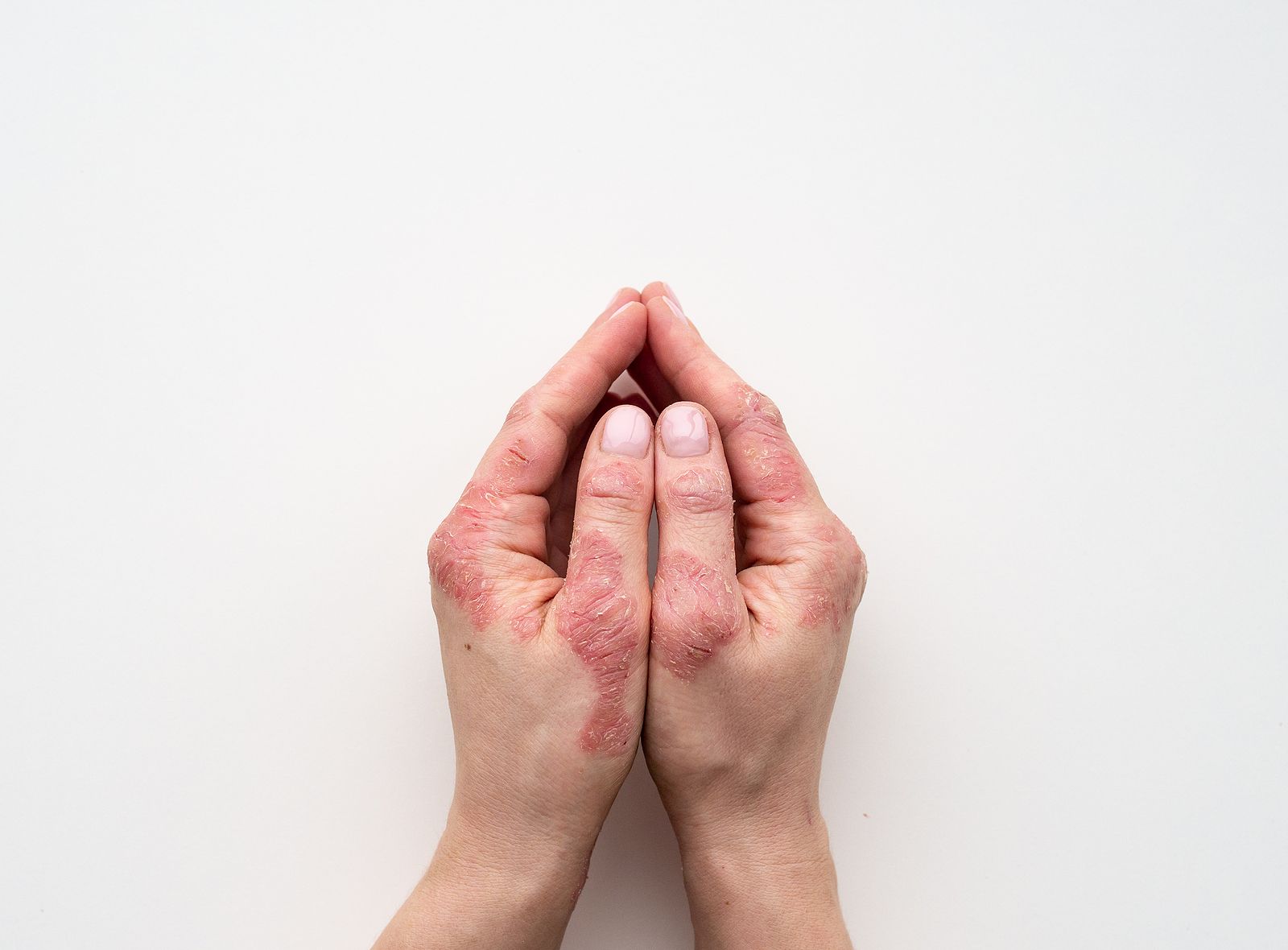 El gran y desconocido coste emocional de la psoriasis  (Bigstock) El gran y desconocido coste emocional de la psoriasis  (Bigstock)