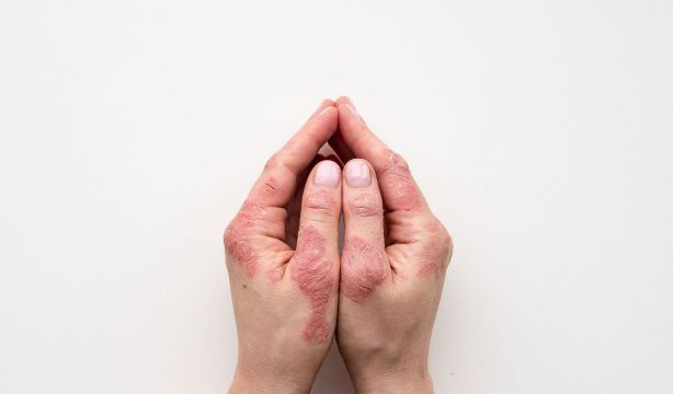 El gran y desconocido coste emocional de la psoriasis  (Bigstock)