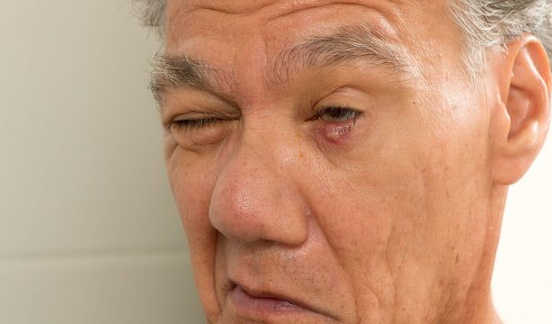 Orzuelos: por qué aparecen realmente y qué hacer para prevenirlos