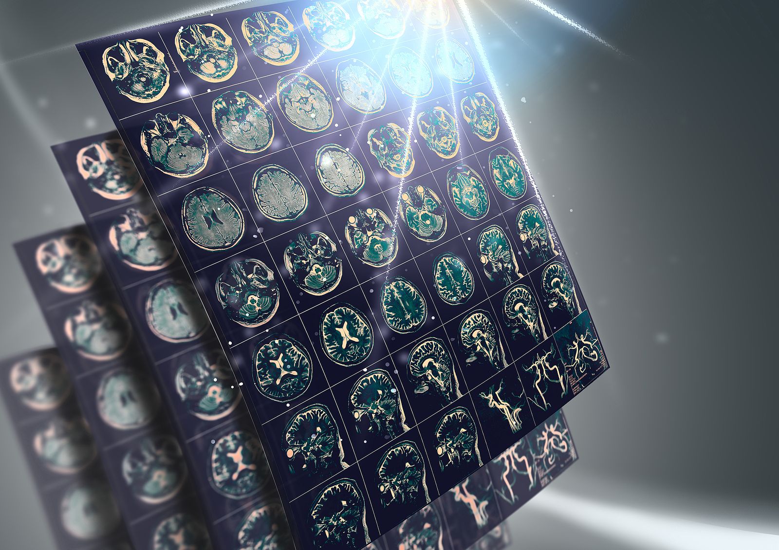 Así se pueden prevenir hasta un 90% de los ictus. (Bigstock) Así se pueden prevenir hasta un 90% de los ictus. (Bigstock)