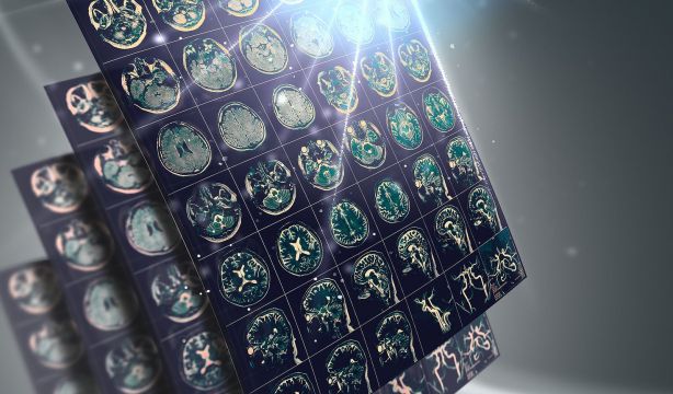 Una nueva herramienta mide la calidad de las grasas y predice el riesgo de ictus isquémico