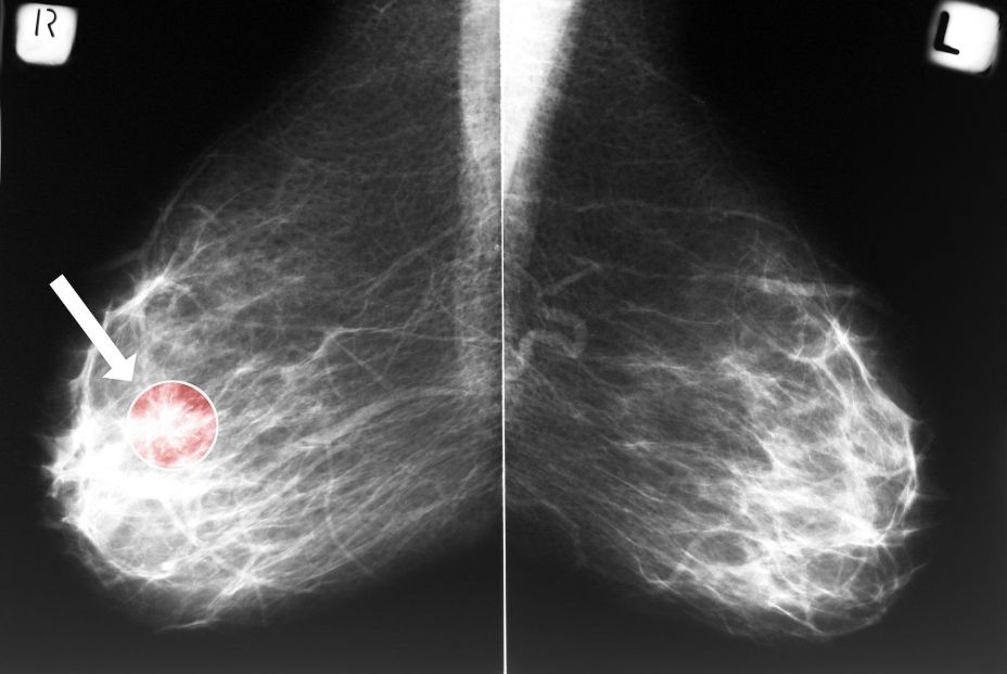 Una mamografía con cáncer de mama- (Bigstock) Una mamografía con cáncer de mama- (Bigstock)