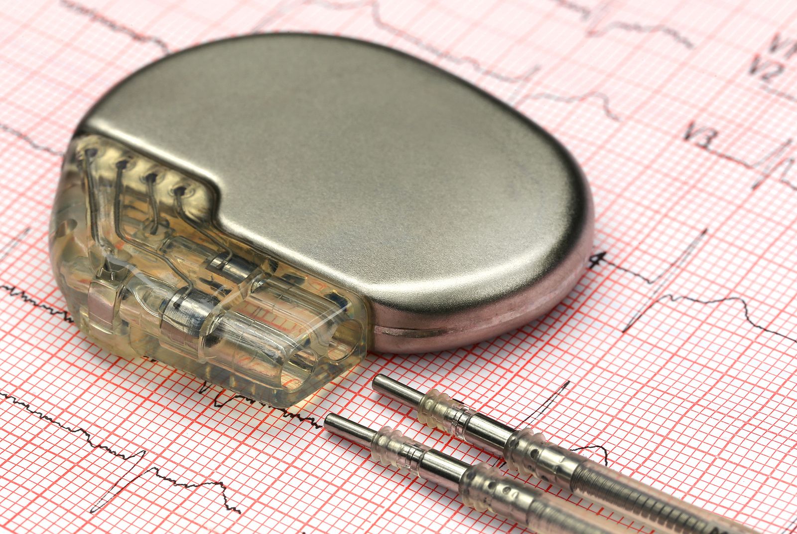 Aumento preocupante de las infecciones por implantes cardíacos o articulares. (Bigstock)