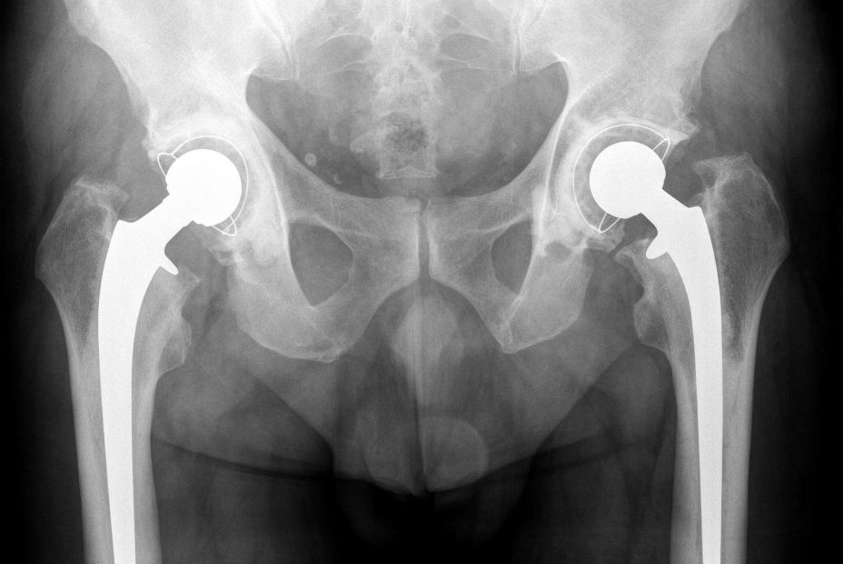 Imagen de una prótesis de cadera. (Bigstock) Imagen de una prótesis de cadera. (Bigstock)