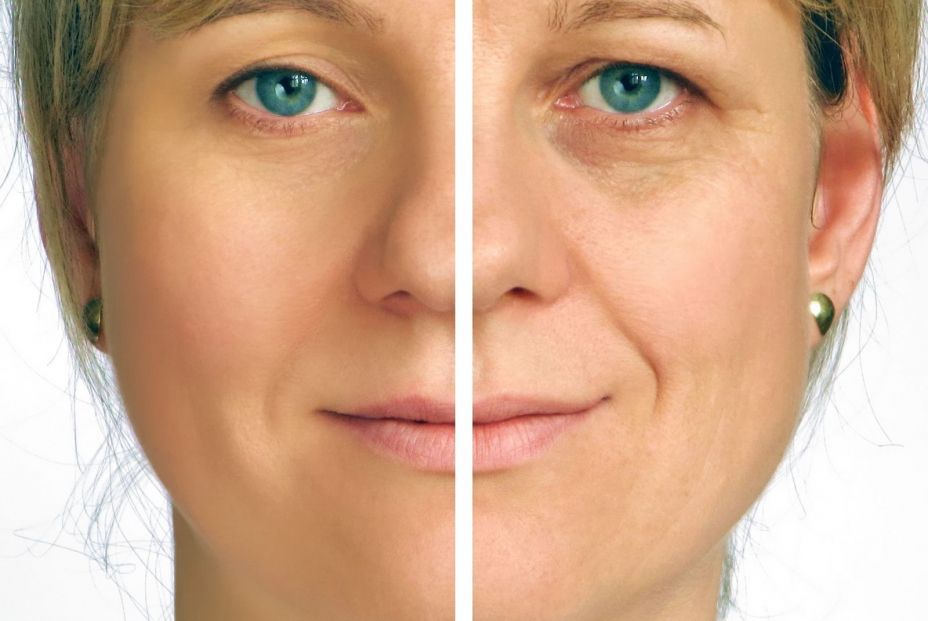 La dermis de una mujer antes y después de la menopausia. (Bigstock) La dermis de una mujer antes y después de la menopausia. (Bigstock)