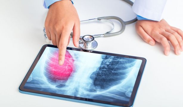 ¿Debería haber límite de edad para un trasplante de pulmón? Hay debate científico