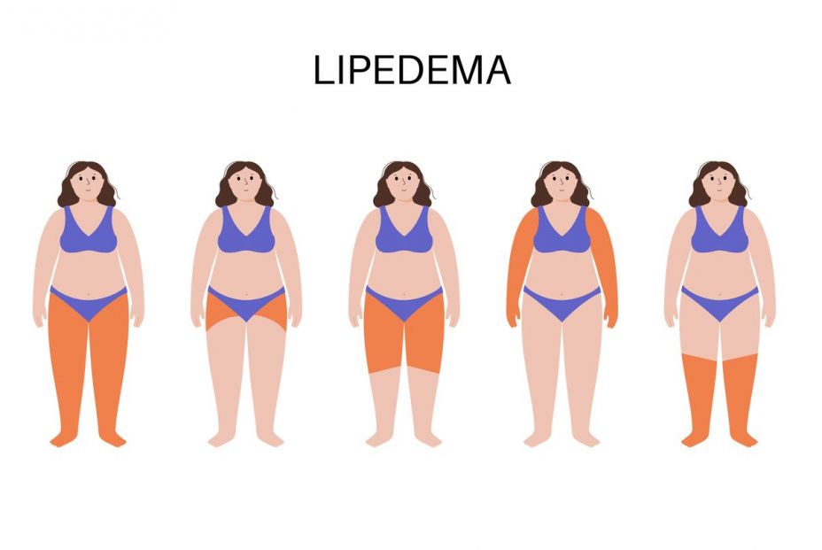 lipedema stock original lipedema stock original